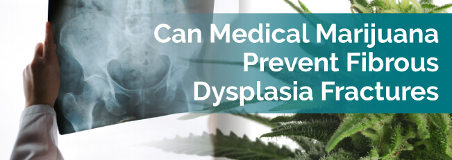 Can Medical Marijuana Prevent Fibrous Dysplasia Fractures?