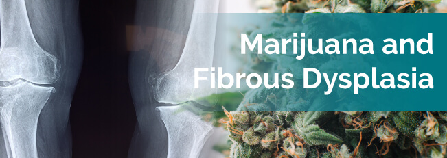 Marijuana and Fibrous Dysplasia