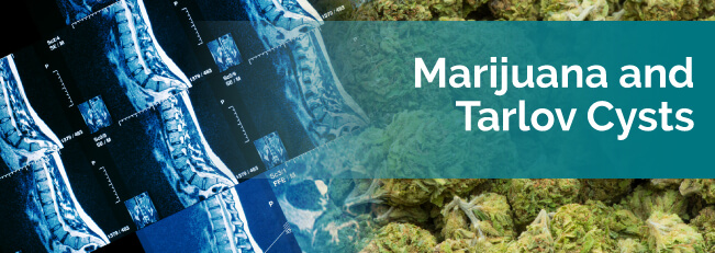 Marijuana and Tarlov Cysts